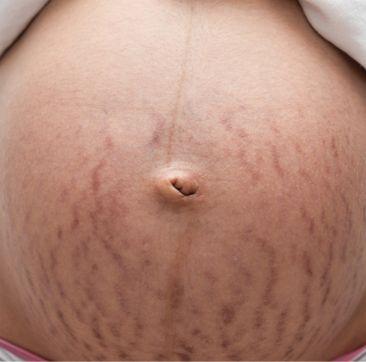 Стрии (растяжки)